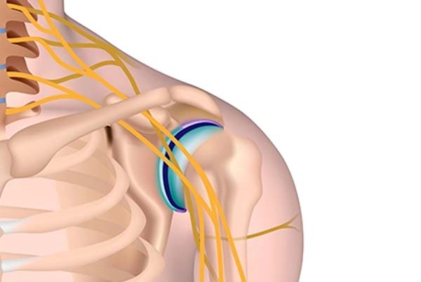 Brachial Plexus Block