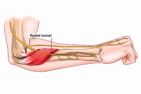 Radial Tunnel Syndrome