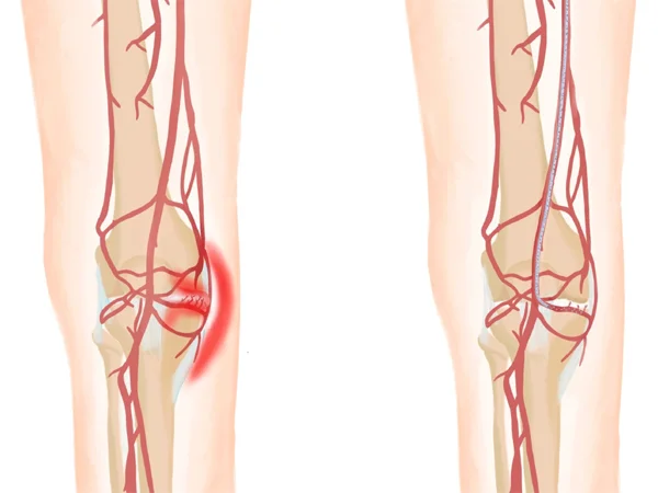 Genicular Artery Embolization Treatment