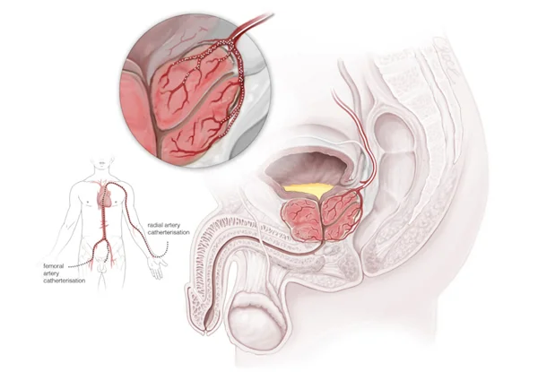 Prostate Enlargement Treatment
