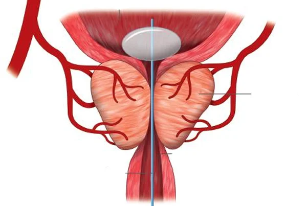 Prostatic Artery Embolization Treatment