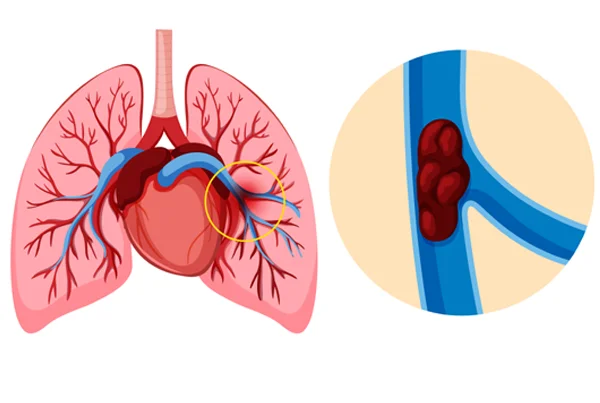 Bronchial Artery Embolization