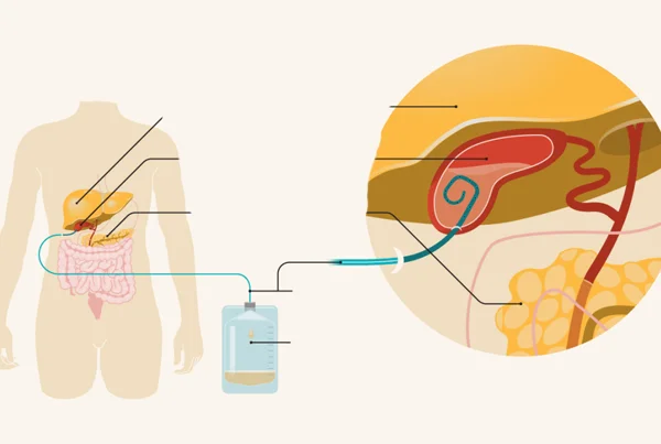 Drainage Procedure
