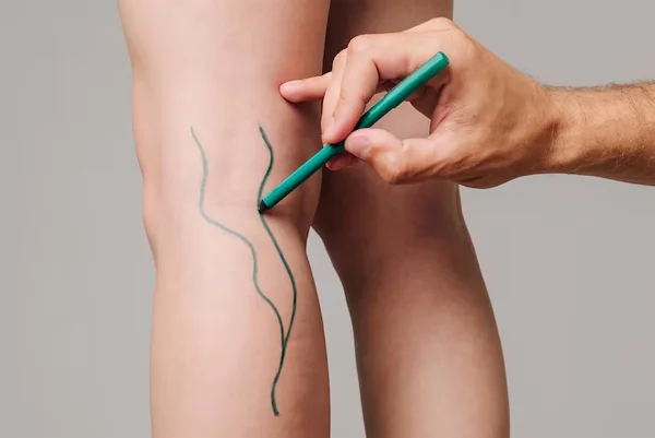 Varicose Veins Ablation
